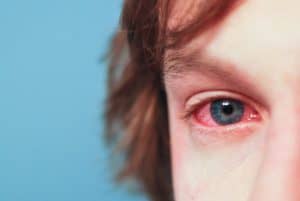 Allergy eyes